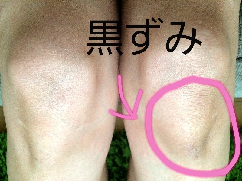 膝の黒ずみ