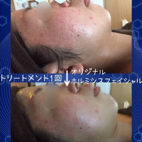 ストレスニキビ
